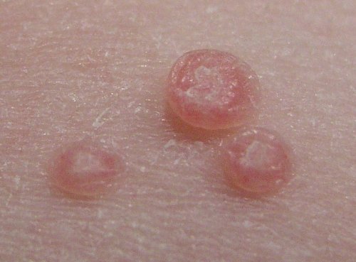 Kälte, Wärme, Geduld und Hartnäckigkeit: Wie Warzen verschwinden