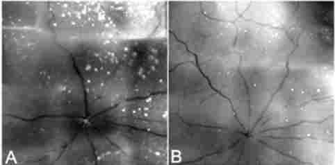 Alzheimer im Auge