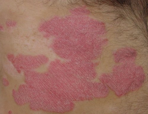 Biologika heilen Haut von innen
