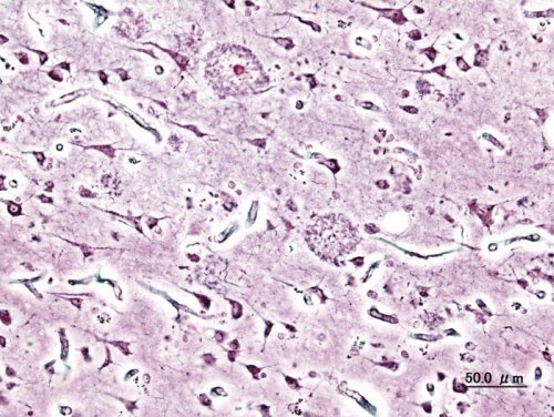 Alzheimer über Nacht