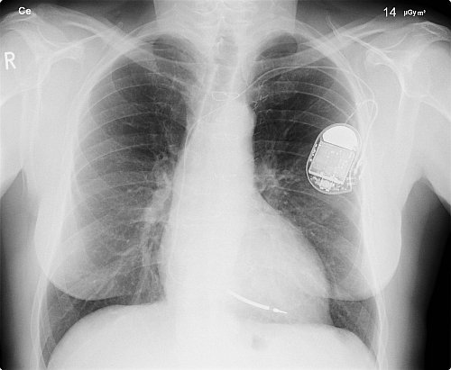 Verpacktes Implantat