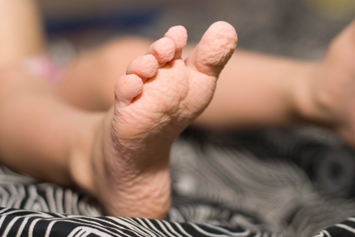 Warum nasse Finger und Zehen Runzeln tragen
