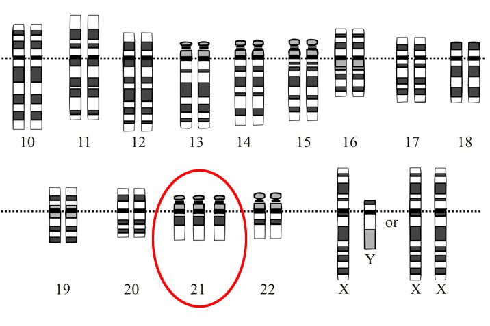 Down-Syndrom: Überzähliges Chromosom stillgelegt