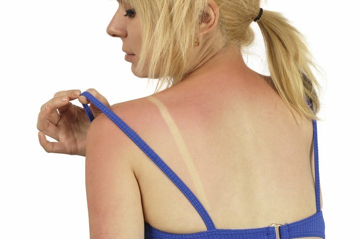 Abhilfe für den Sonnenbrand