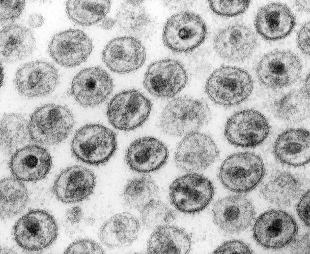 HIV-Heilmittel in Sicht?