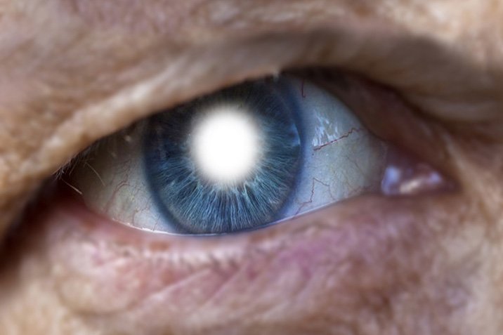 Ohne Spritze gegen Makuladegeneration
