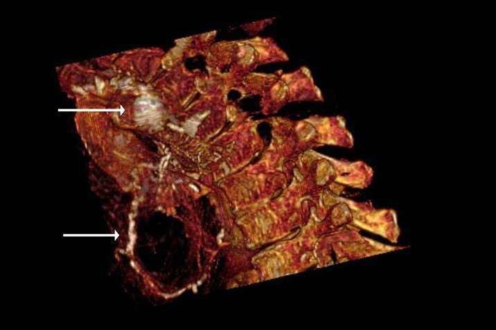 Rätsel der Mumien-Arteriosklerose gelöst?