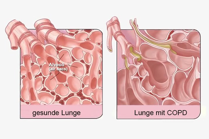 Hoffnung für COPD-Patienten?