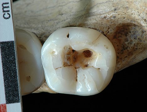Zahnmedizin ist 5000 Jahre älter als gedacht