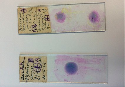 Malaria-Geschichte in alten Blutproben