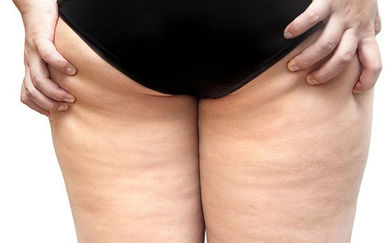 Warum ist Cellulite typisch weiblich?
