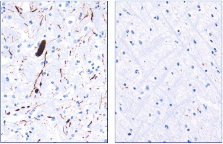 Schutz vor Protein-Klumpen im Gehirn