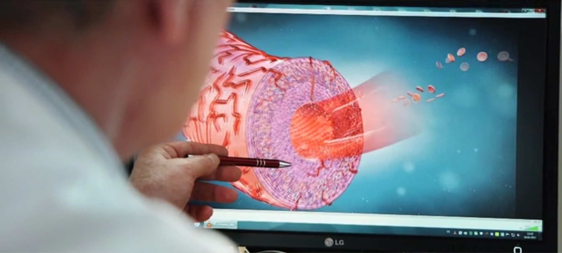 Neue These zur Ursache von Arteriosklerose