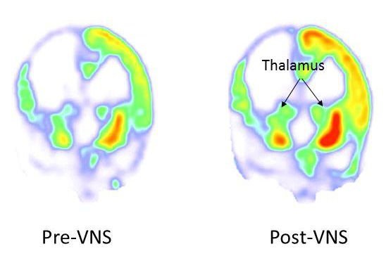 Durch Nervenstimulation aus dem Wachkoma