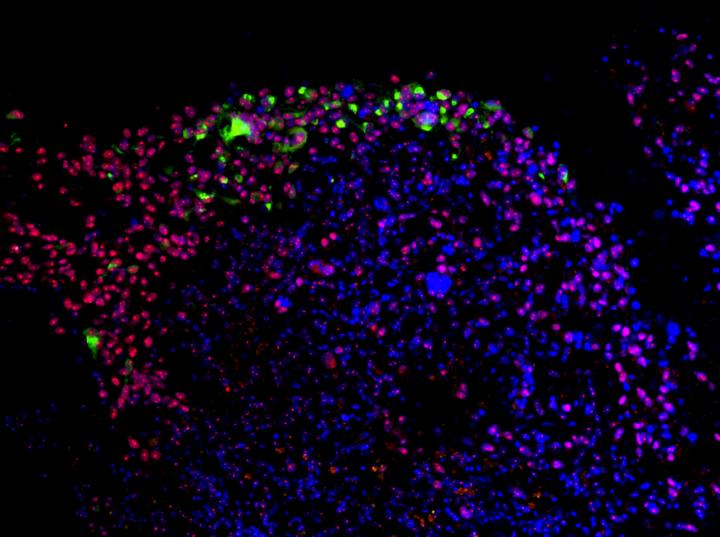 Zika-Virus als Waffe gegen Hirntumore