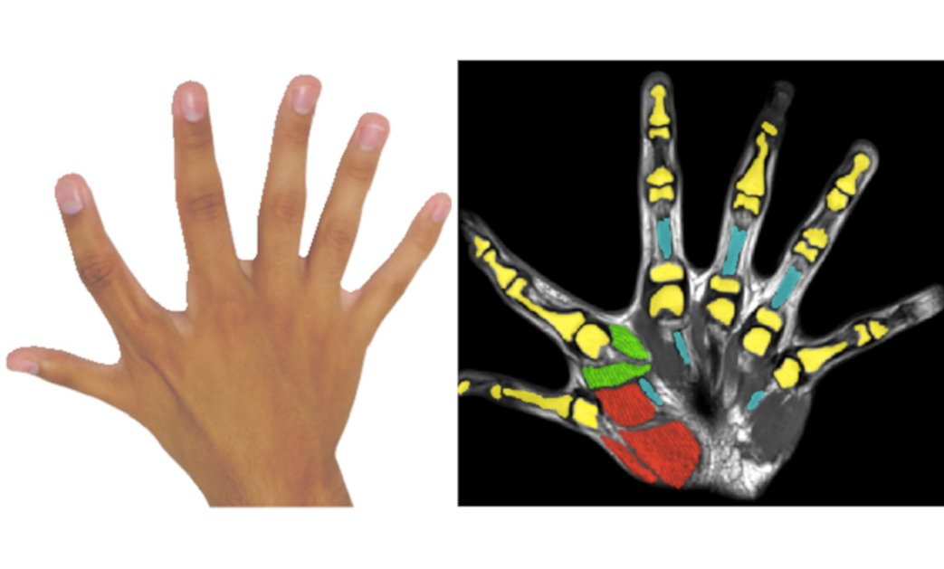 Kann ein sechster Finger vorteilhaft sein?