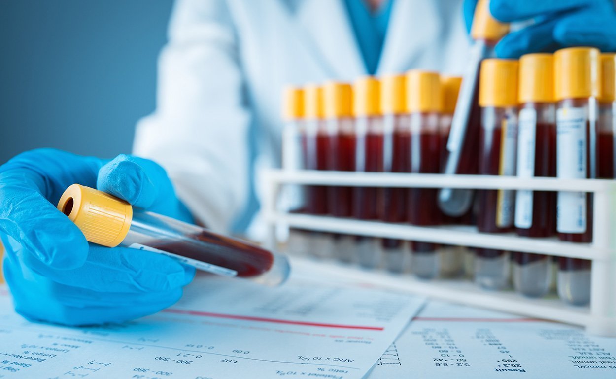 Blutmarker für die Alzheimer-Prognose