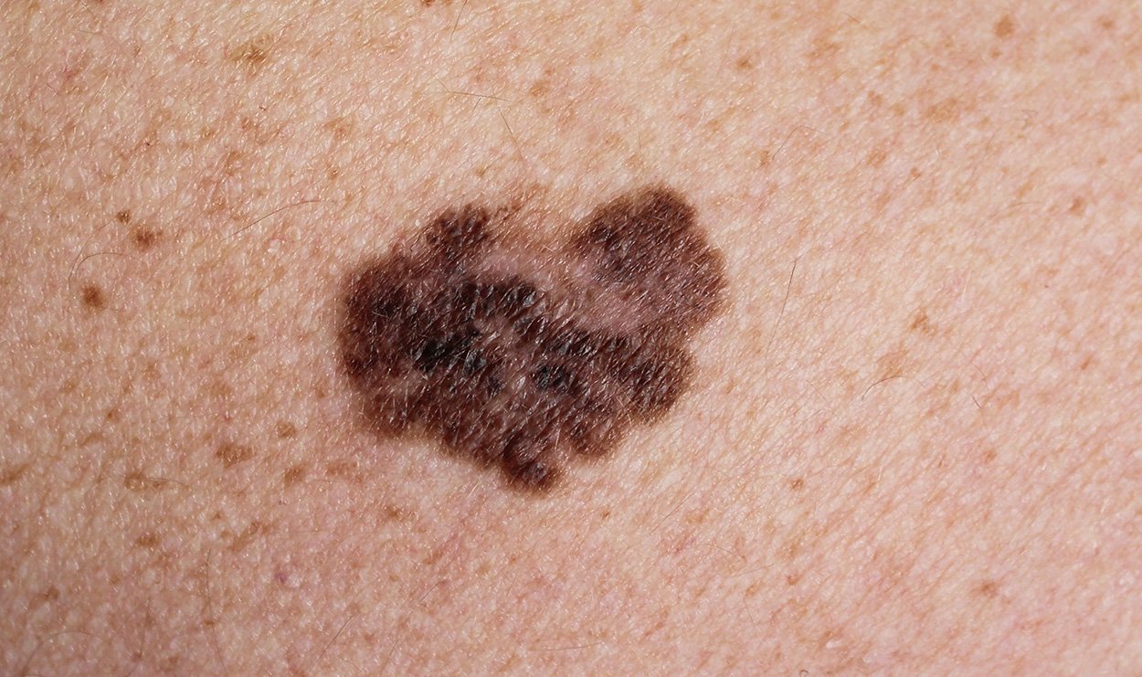 Kot-Übertragung könnte Krebstherapie wirksamer machen