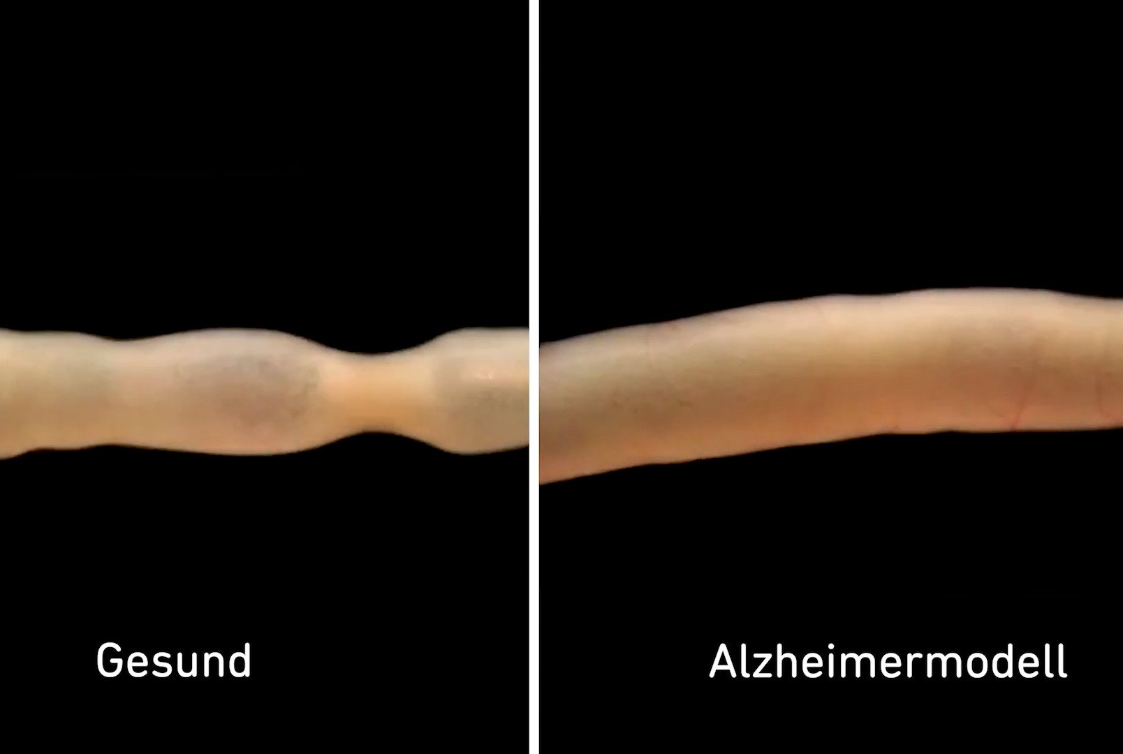 Alzheimer im Darm-Nervensystem