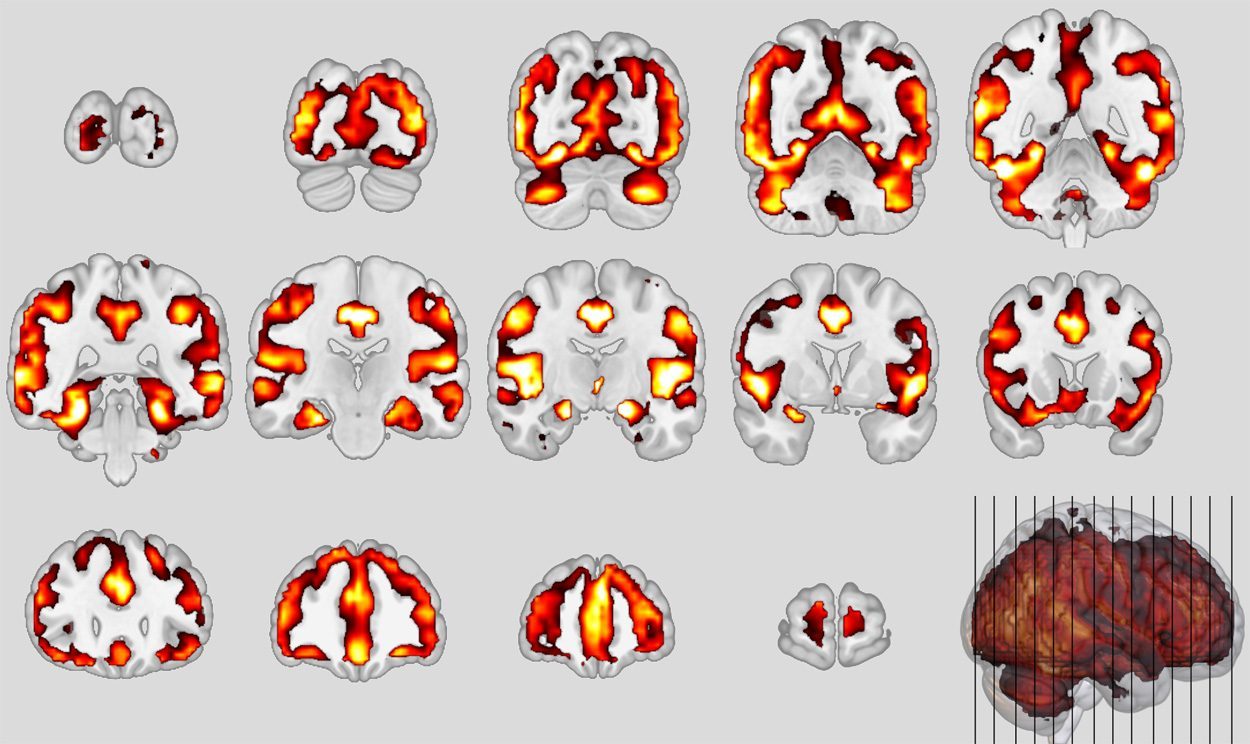 Ähnlichkeiten zwischen Schizophrenie und Demenz entdeckt