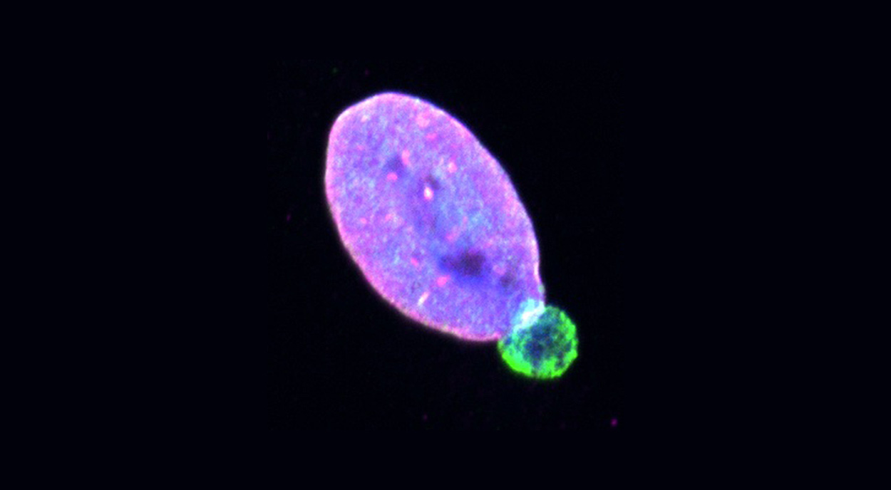 Wie ein Protein Hautkrebs-Metastasen fördert