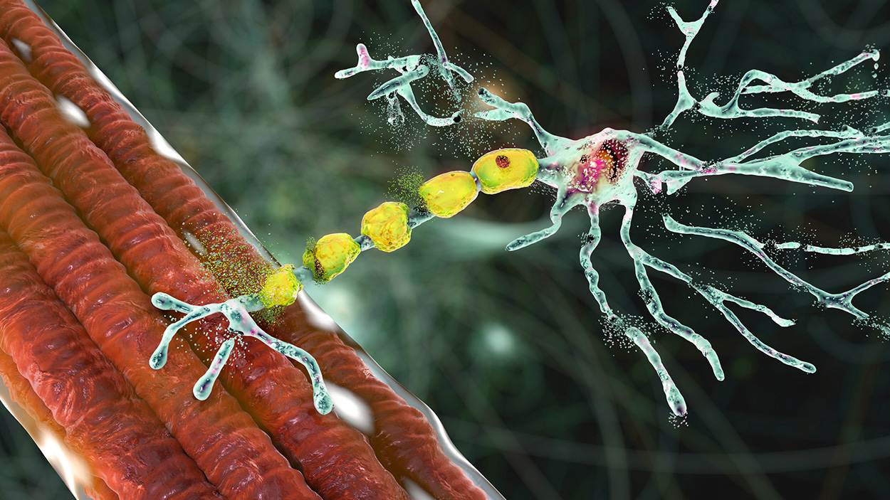 Parkinson-Medikament gegen ALS?