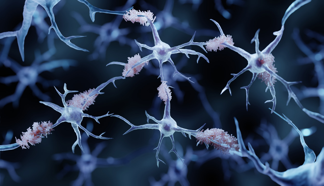 Medikament verlangsamt Fortschreiten von Alzheimer