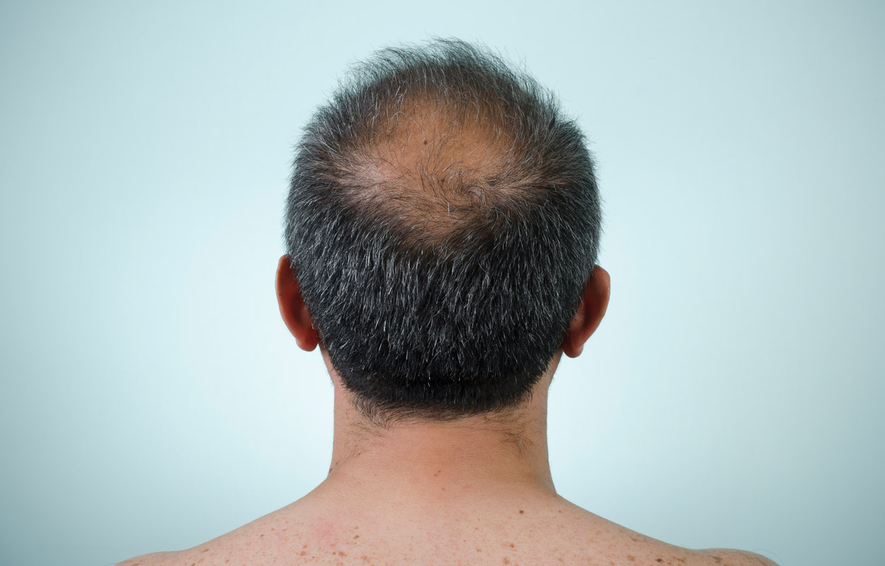 Neue Genvarianten für Haarausfall bei Männern entdeckt
