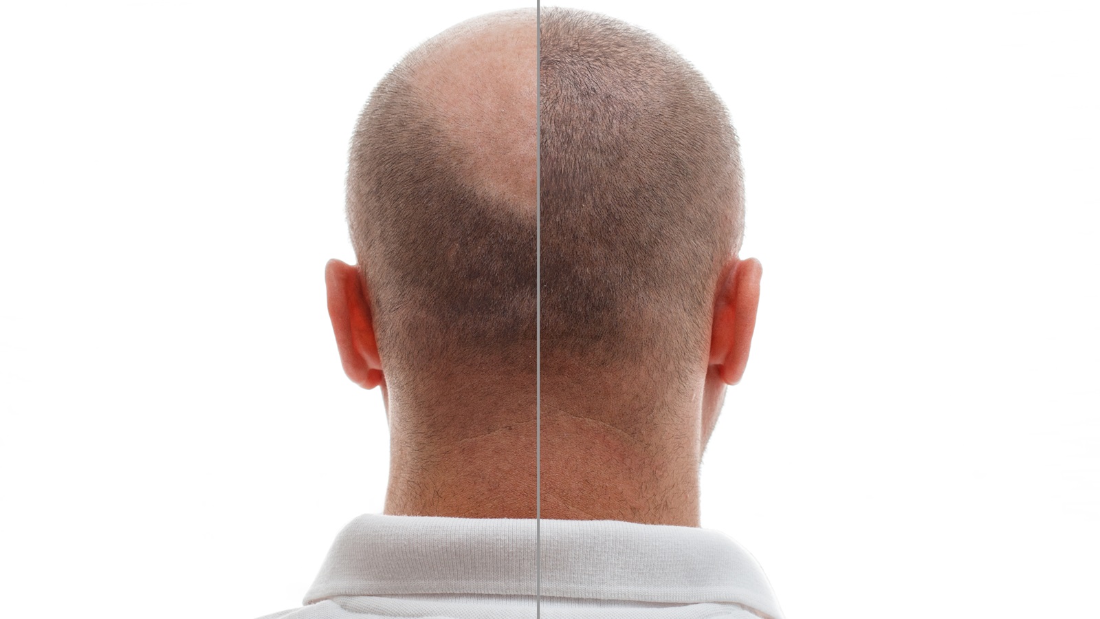 Haartransplantation Türkei – neue Erfindung sorgt für perfekte Ergebnisse