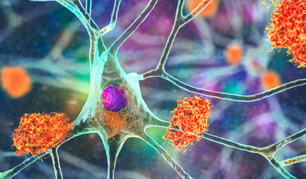 Kontaminierte Wachstumshormone übertrugen Alzheimer