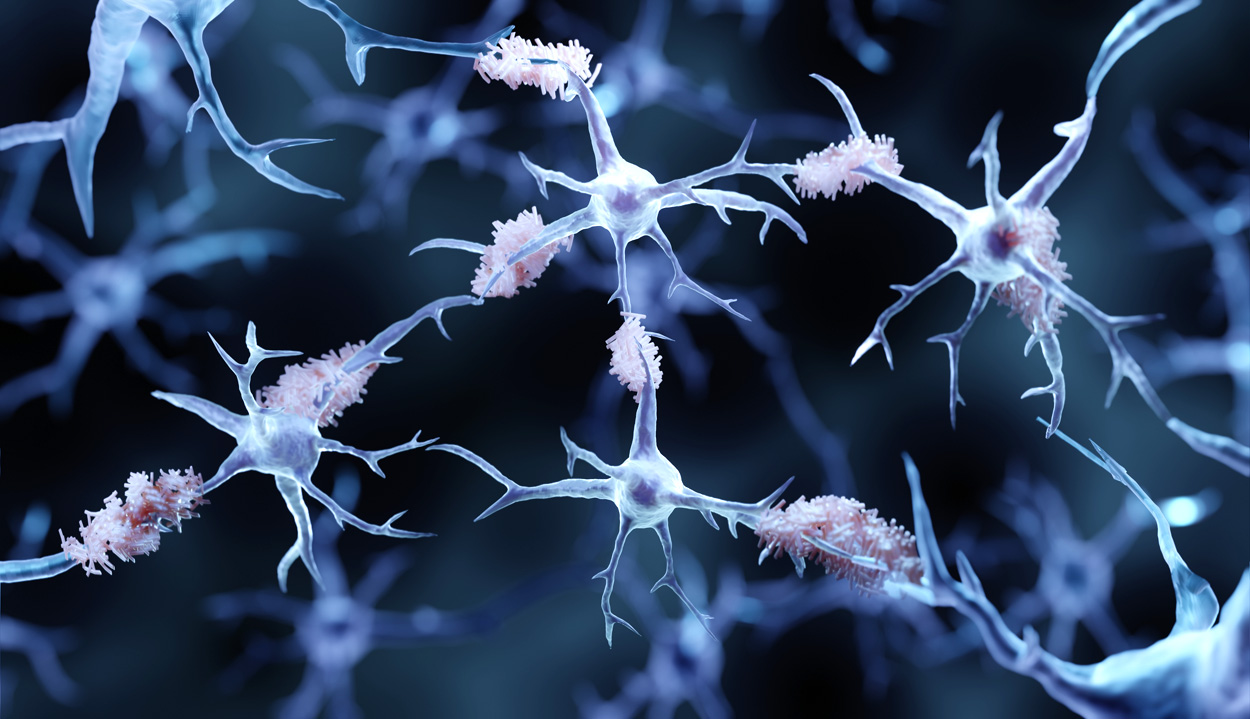 Parkinson-Plaques rauben den Hirnzellen Energie