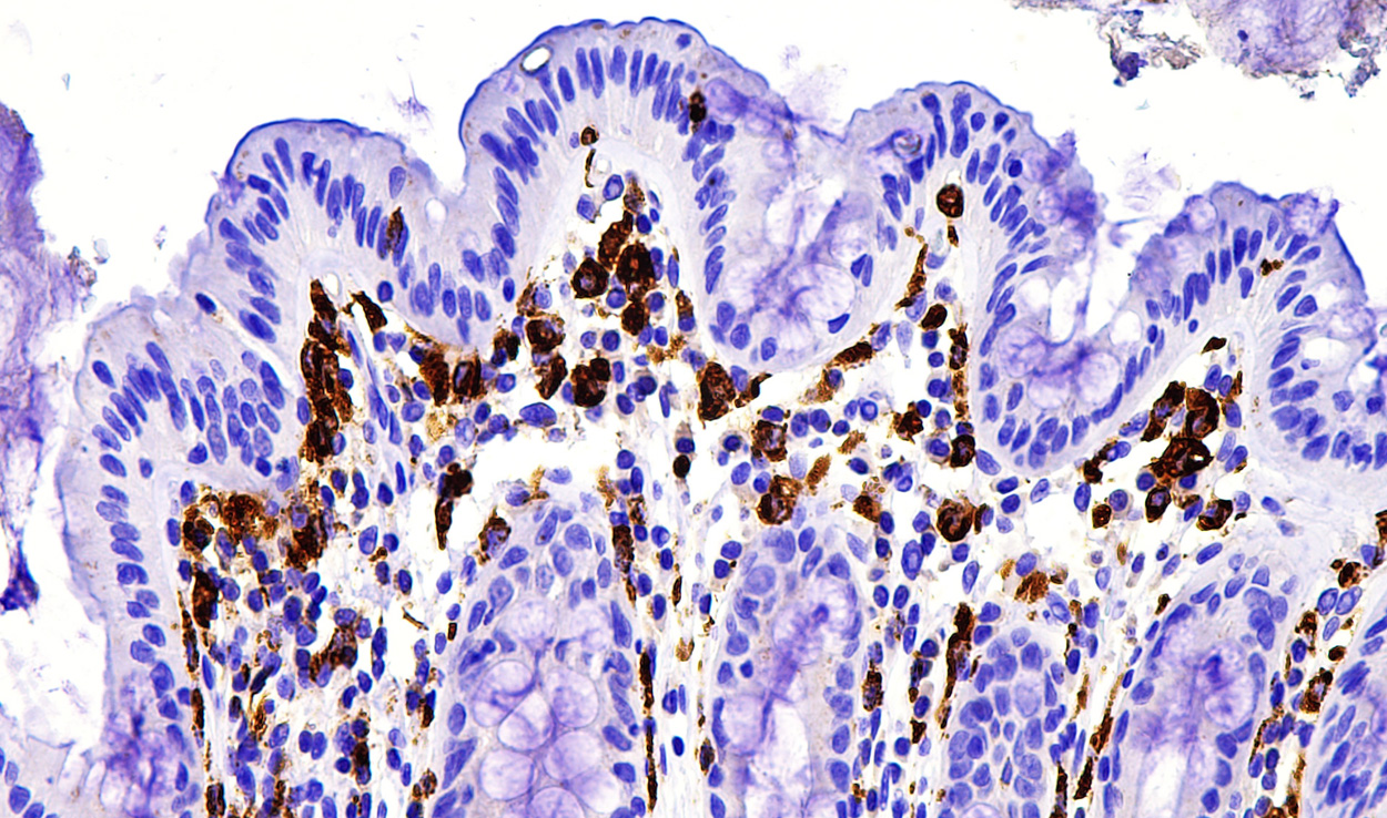 Bakterielles Gift verschlimmert Colitis ulcerosa