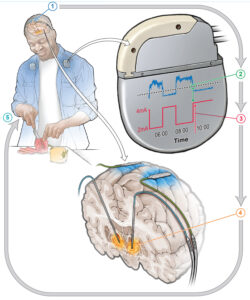 Illustration der Wirkweise des intelligenten Hirnschrittmachers
