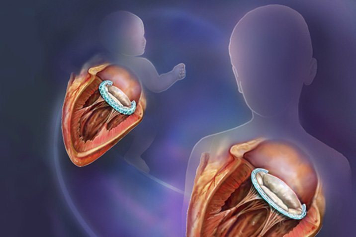Ein mitwachsendes Implantat