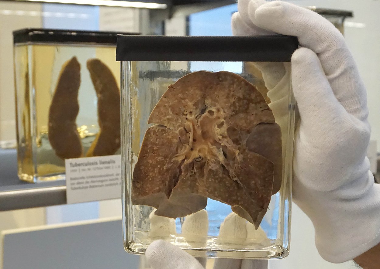 Masern entstanden schon vor 2500 Jahren