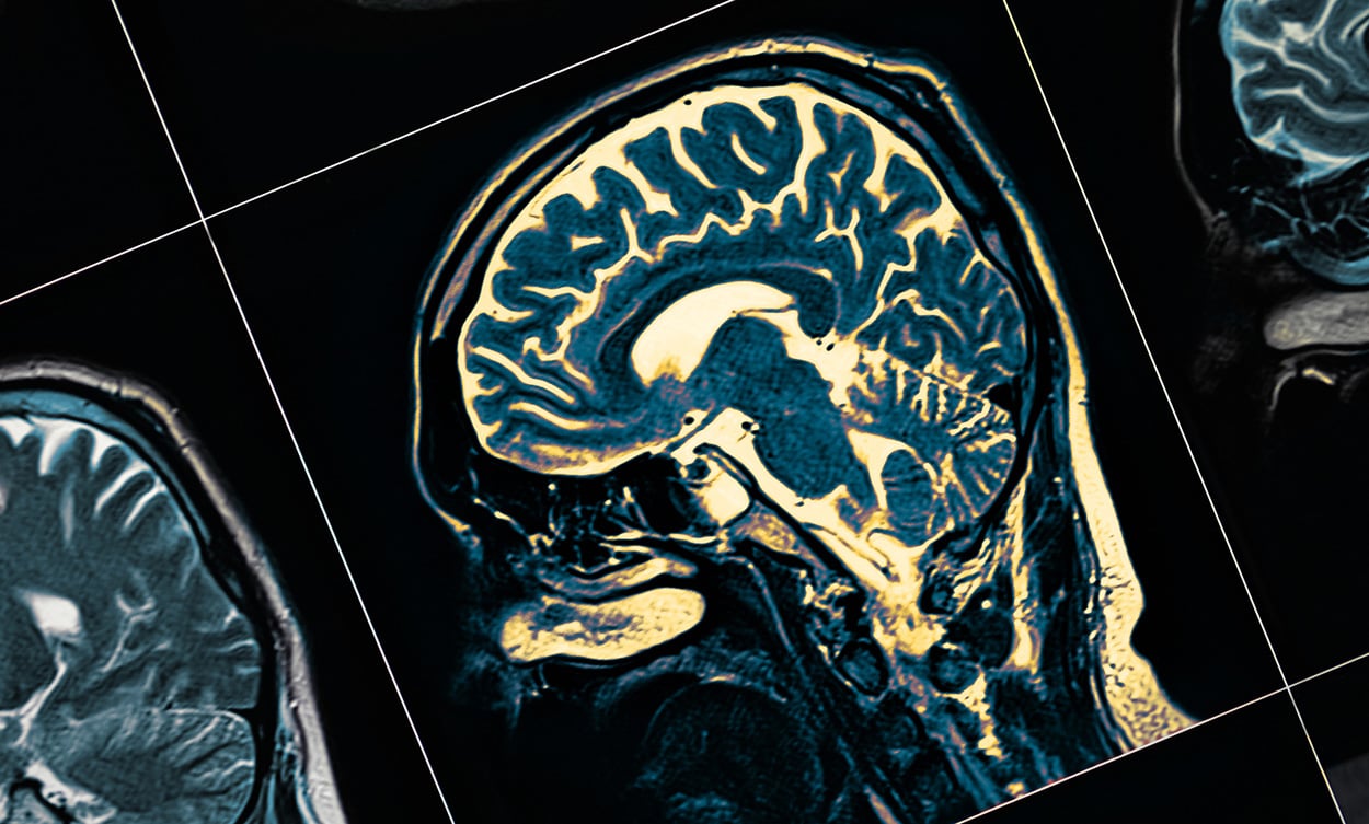 Seltene Mutation schützt vor Alzheimer